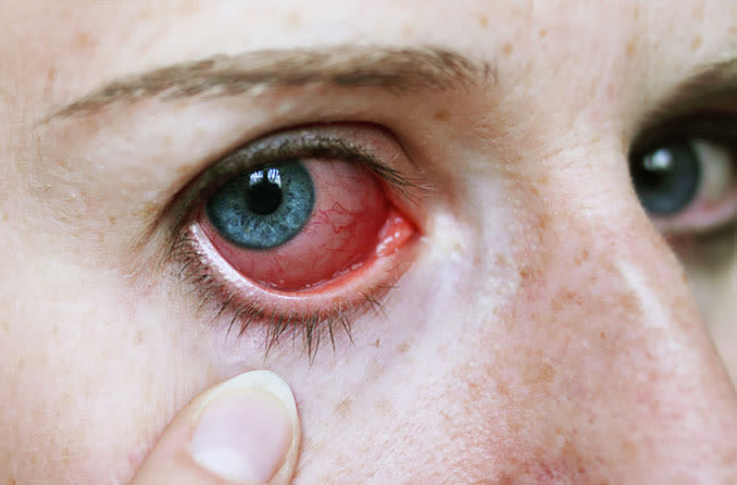 Menina puxa a pálpebra para baixo para mostrar o olho irritado vermelho