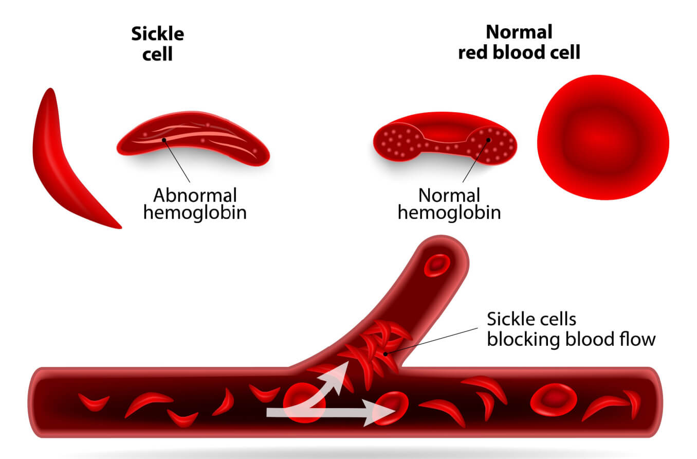 Depiction of a normal red blood cell and a sickle cell