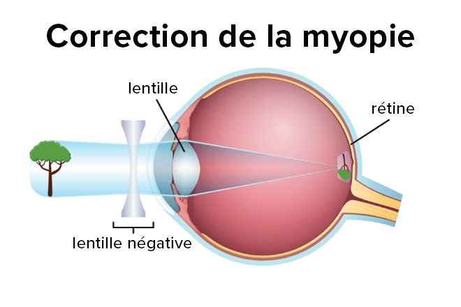 schéma de la façon dont une lentille concave corrige la myopie