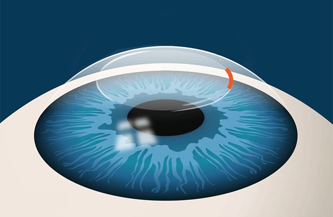 illustration de l'incision de la chirurgie oculaire au laser SMILE