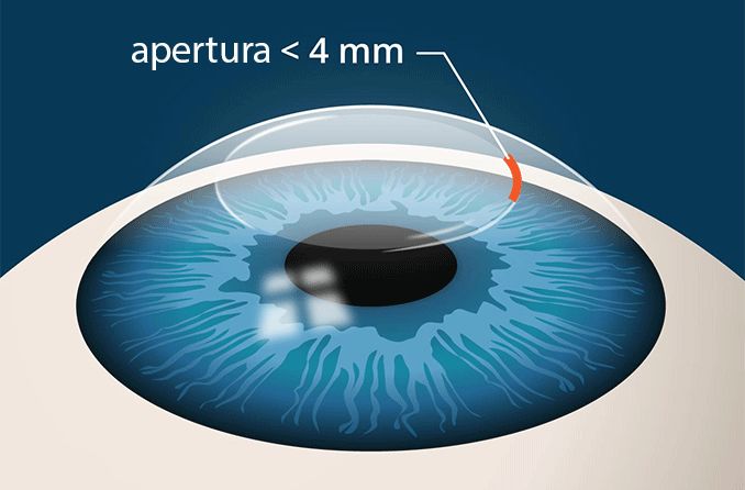 Ilustración de la incisión de cirugía ocular con láser SMILE