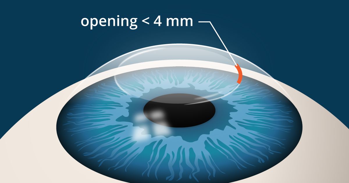illustration of SMILE laser eye surgery incision