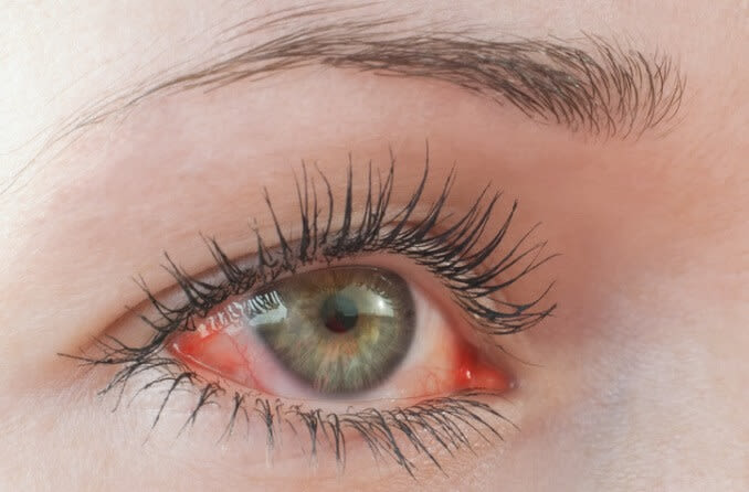 Depiction of the allergic infection chemosis