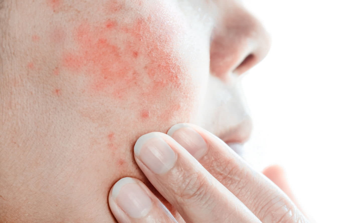 Red rashes appear on woman's face.
