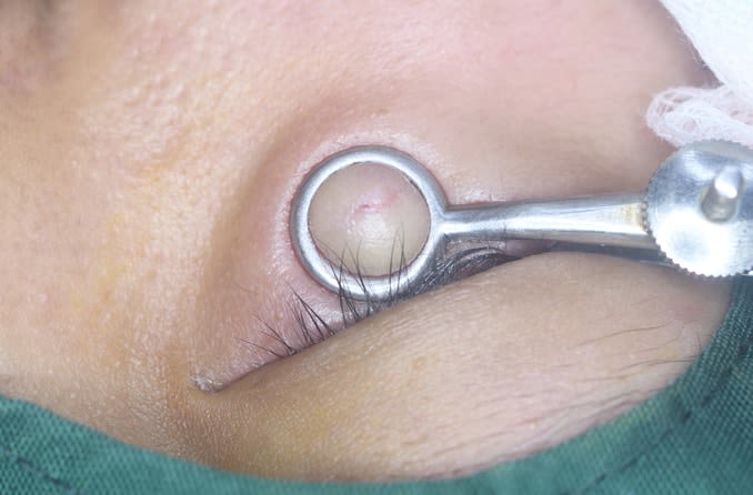 Close-up image of a lower eyelid being prepared for stye removal