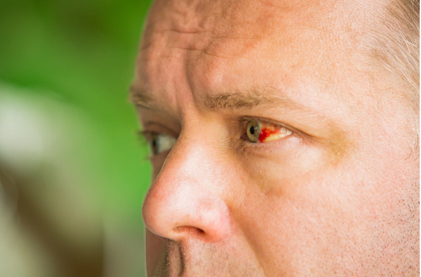 Close up of man with broken blood vessel in eye