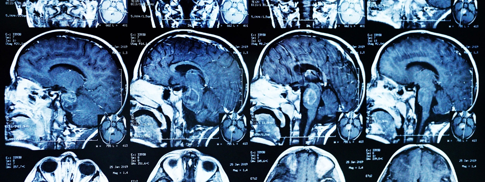 brain-cancer-scan-scaled.jpg