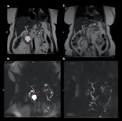 A series of four MRI and MRCP scans of a precancerous pancreatic cyst. Images on left have a brighter spot toward the middle