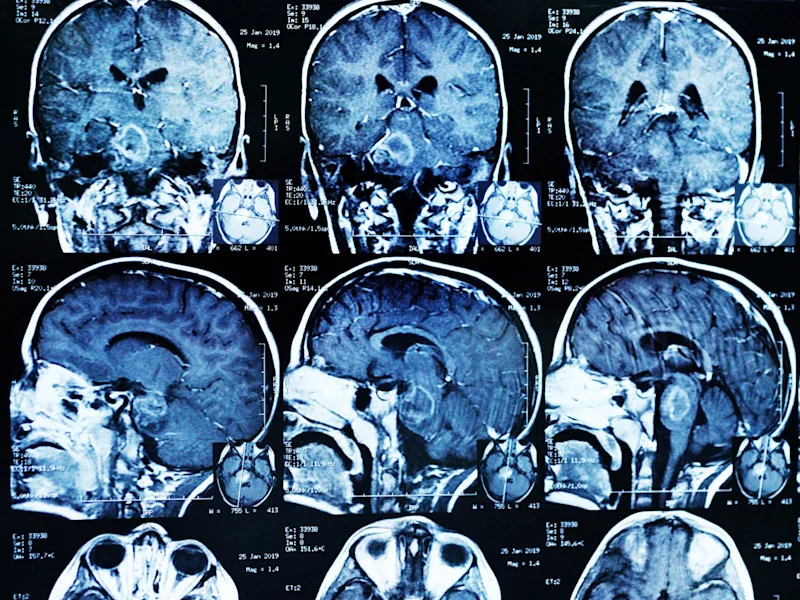 Images of brain MRI scans showing a tumor in a person's head are seen on a dark background.