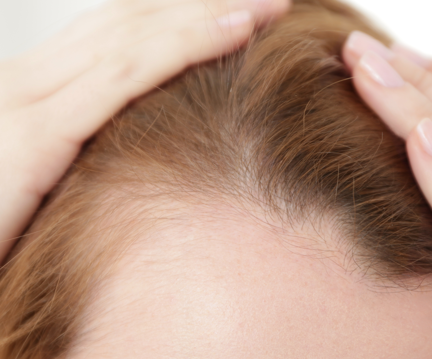 Hair Loss in Women Causes and Treatments for Every Age  GoodRx