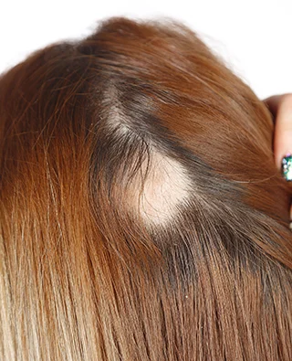 Female Pattern Baldness - Causes & Solutions Banner Image