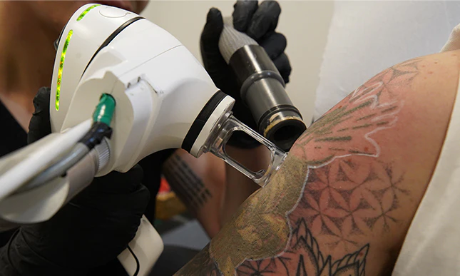 10 things to consider when choosing a tattoo removal clinic