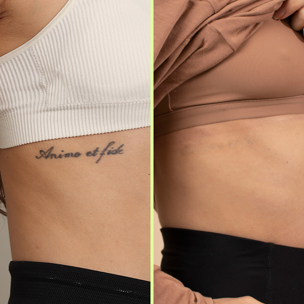 Ribs tattoo removal