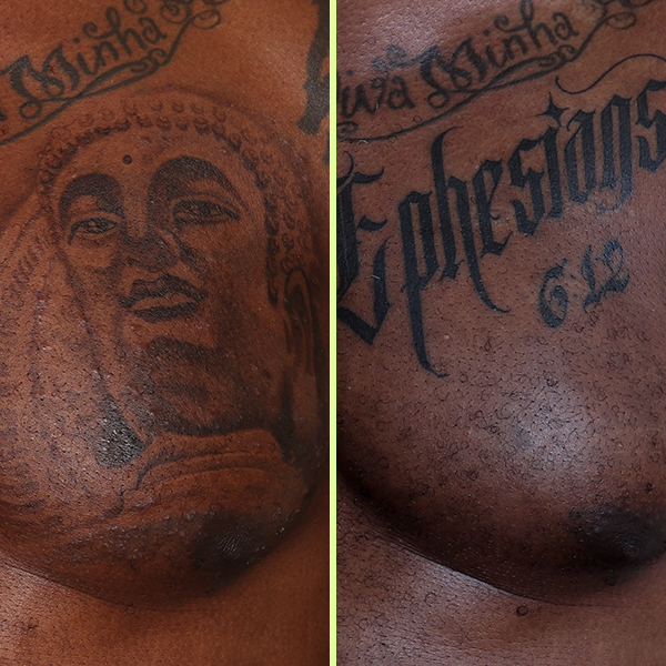 Removal for a cover-up: “It’s gone. I’m still amazed. The tattooist that I went to was amazed.”