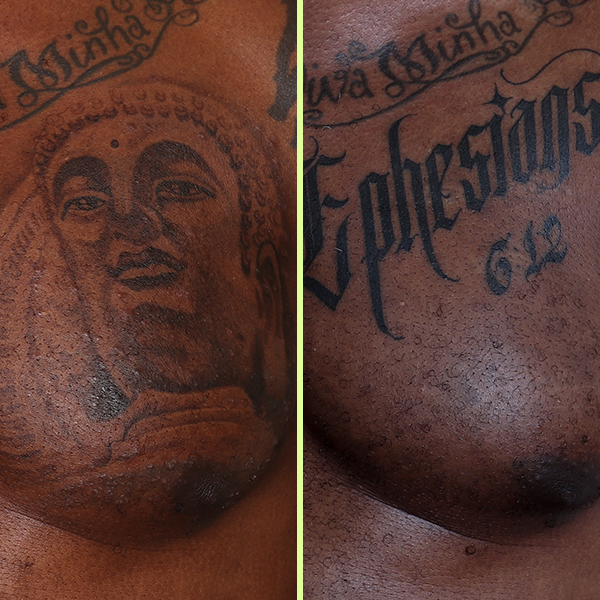 Chest tattoo removal