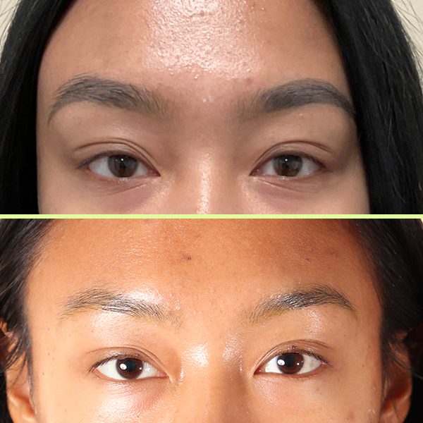 Eyebrow tattoo removal