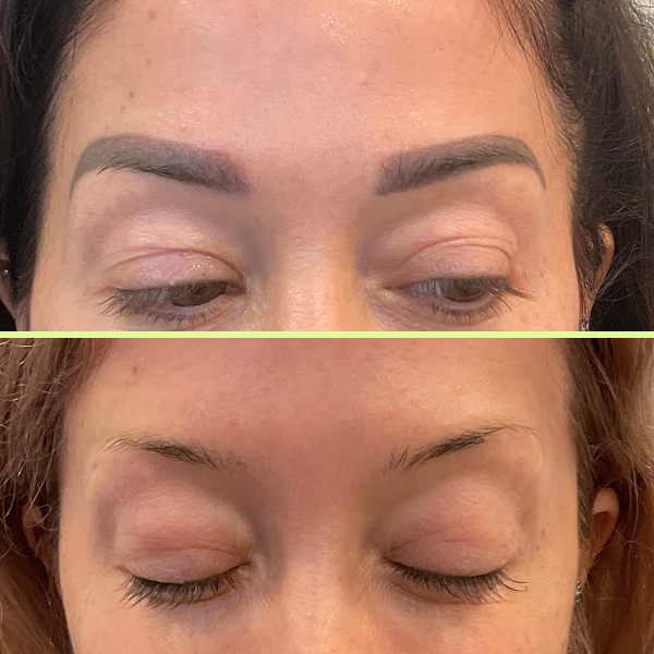 Eyebrow tattoo removal