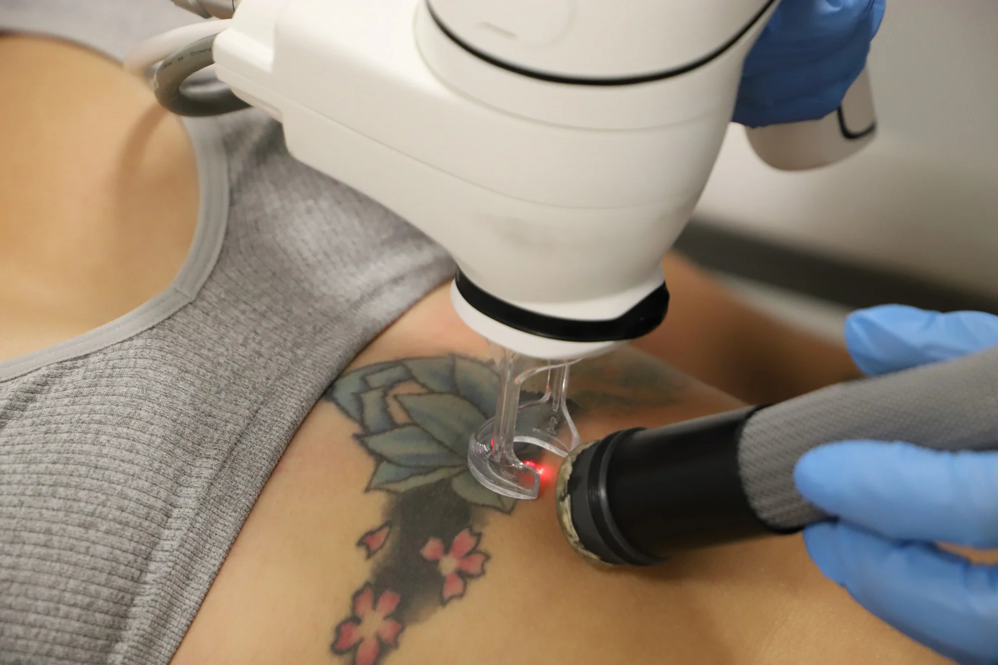 Efficient removal of unwanted tattoos using advanced lasers