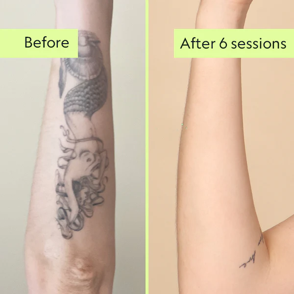 Laser Tattoo Removal Cost And WaysIt Can Help You Land A Job