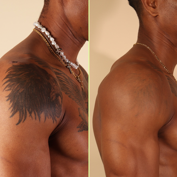 Shoulder tattoo removal