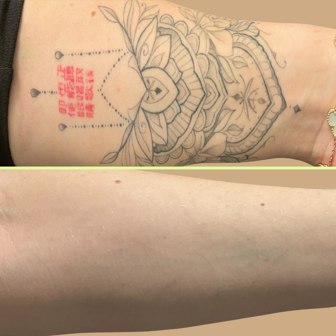 Arm tattoo removal