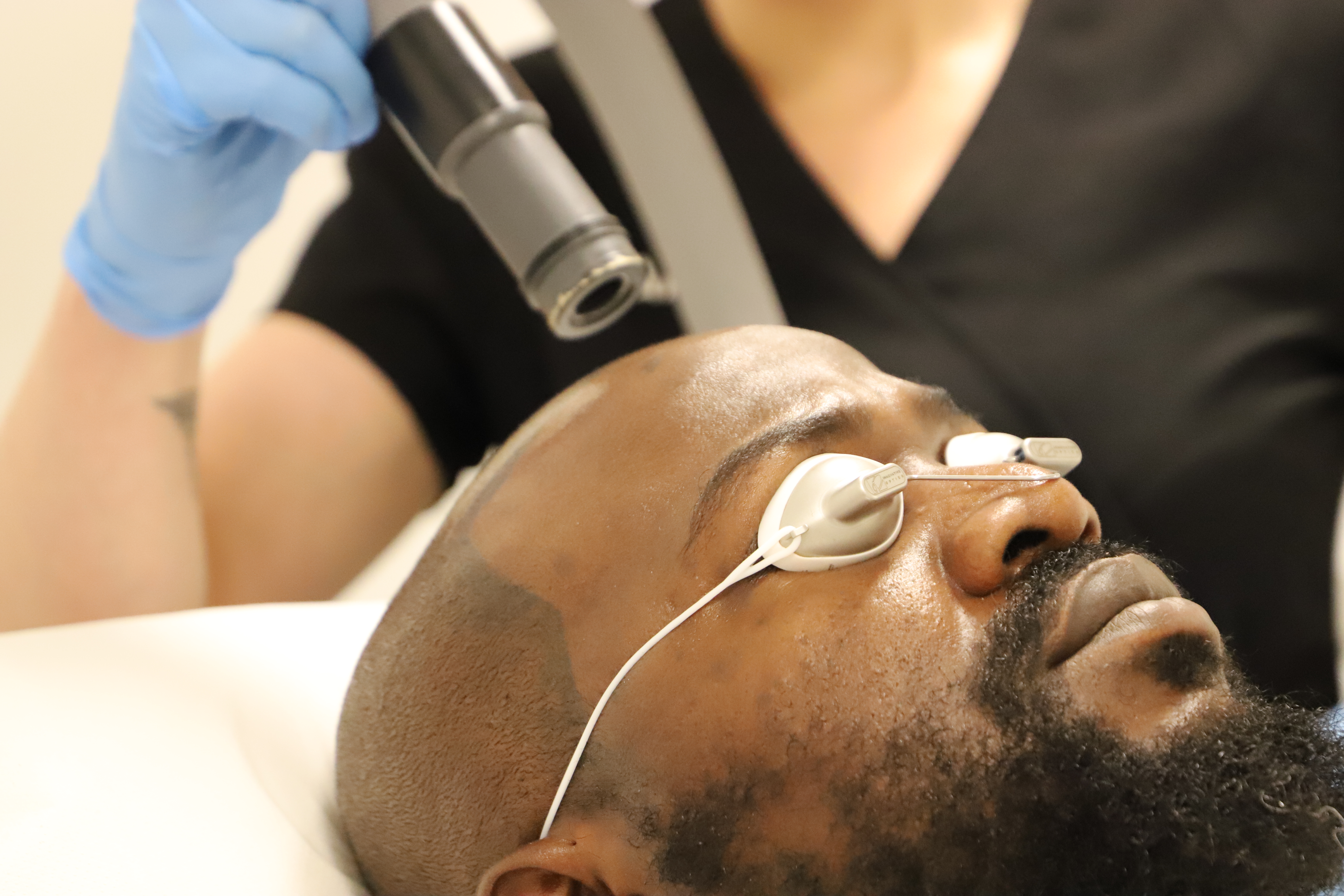 Uyi Scalp Tattoo Removal London