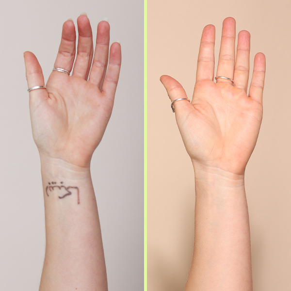 Wrist tattoo removal