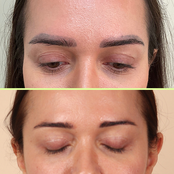 Eyebrow tattoo removal