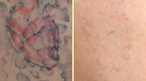 Color tattoo removal