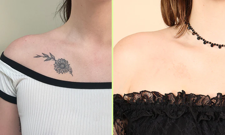 Before and after image illustrating how long laser tattoo removal takes
