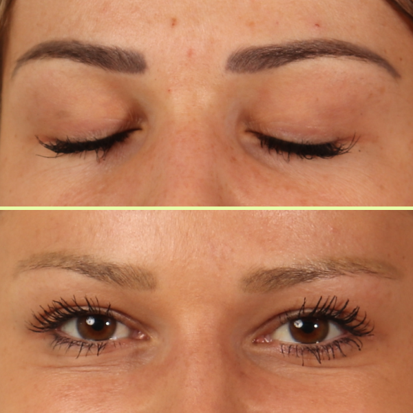 Eyebrow tattoo removal