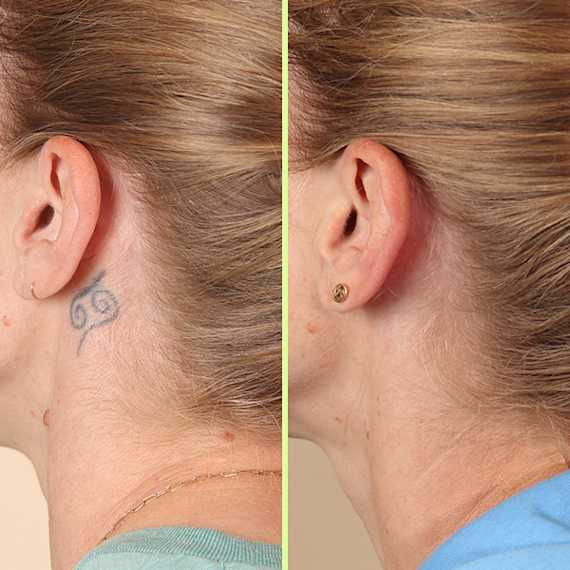 Neck tattoo removal