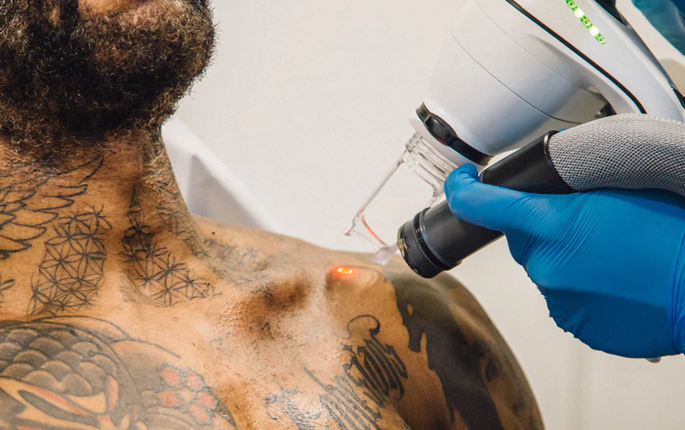 Main image showing less painful LightSense™ tattoo removal