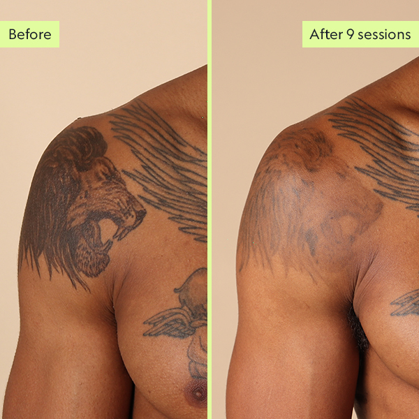 Bilal tattoo removal before and after