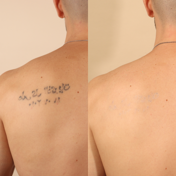 Shoulder tattoo removal
