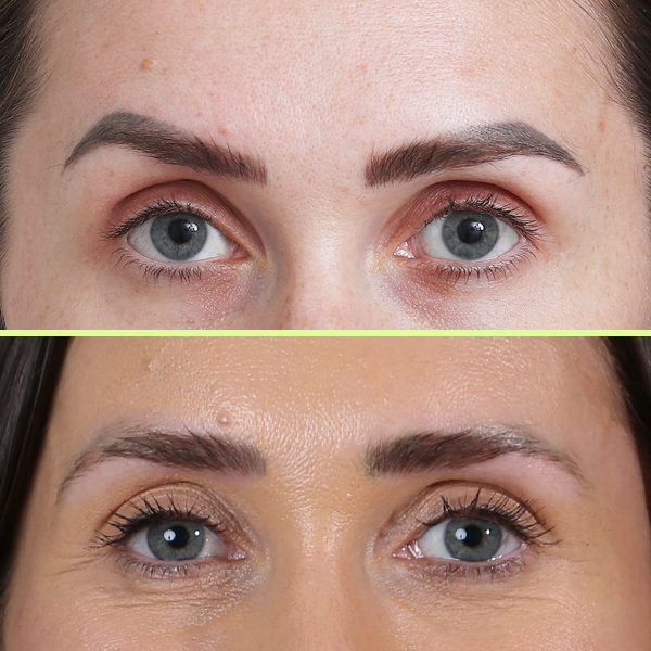 Eyebrow tattoo removal