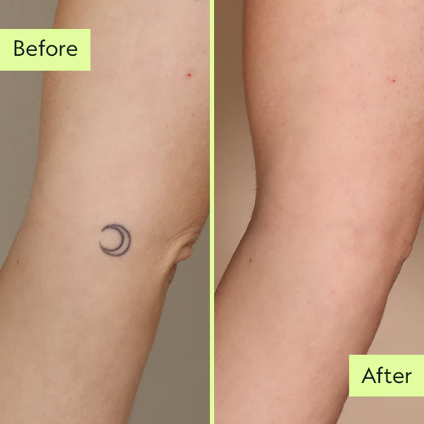 TOG Permanent Tattoo Removal Cream Natural Fades Away Maximum Strength  13g  Amazonin Beauty