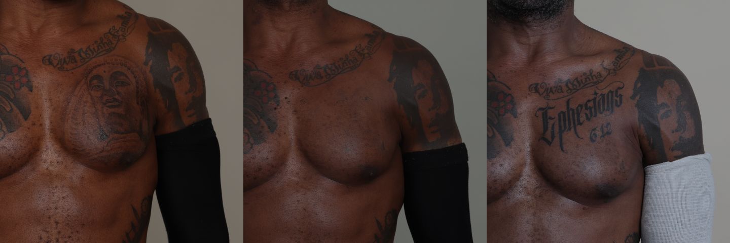 Fading for cover-up tattoos