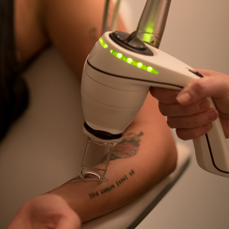 Removal with the world-leading LightSense™ laser
