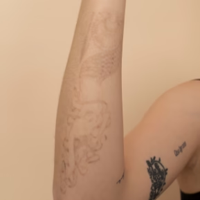 Tattoo removal progress after just 2 sessions
