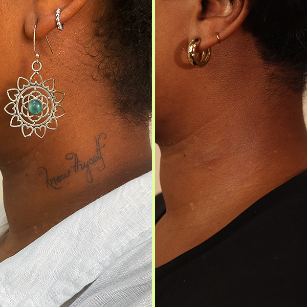 Neck tattoo removal