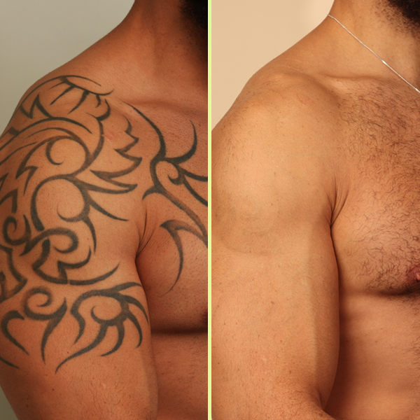 Arm tattoo removal