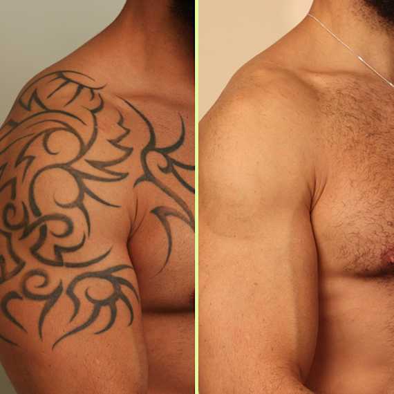 Arm tattoo removal