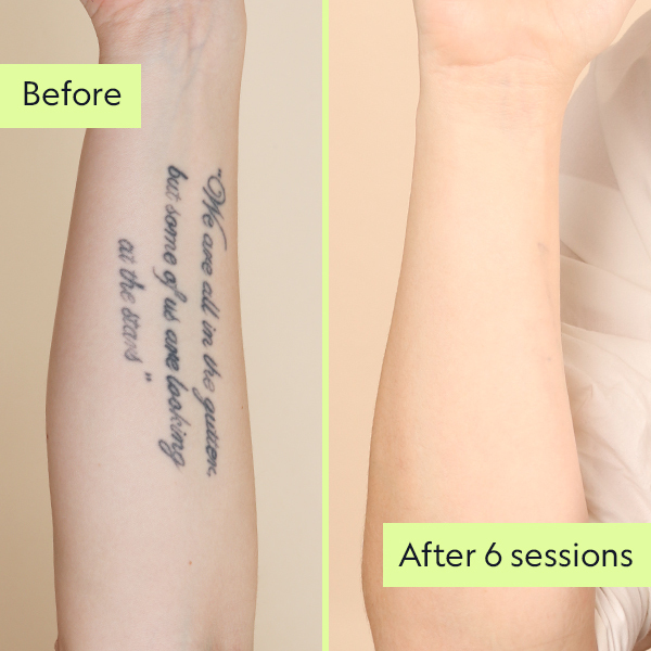 Image showing professional tattoos removed in 6 sessions