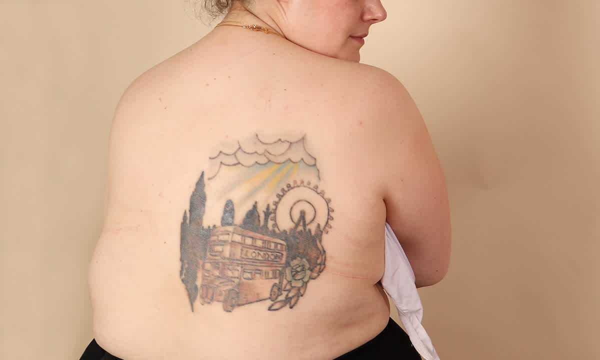 London Tattoo Removal Great Portland Street