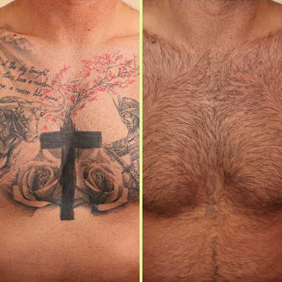 Chest tattoo removal