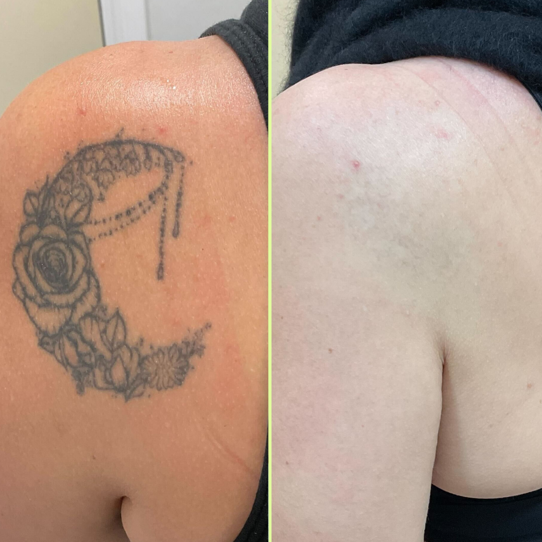 Shoulder tattoo removal