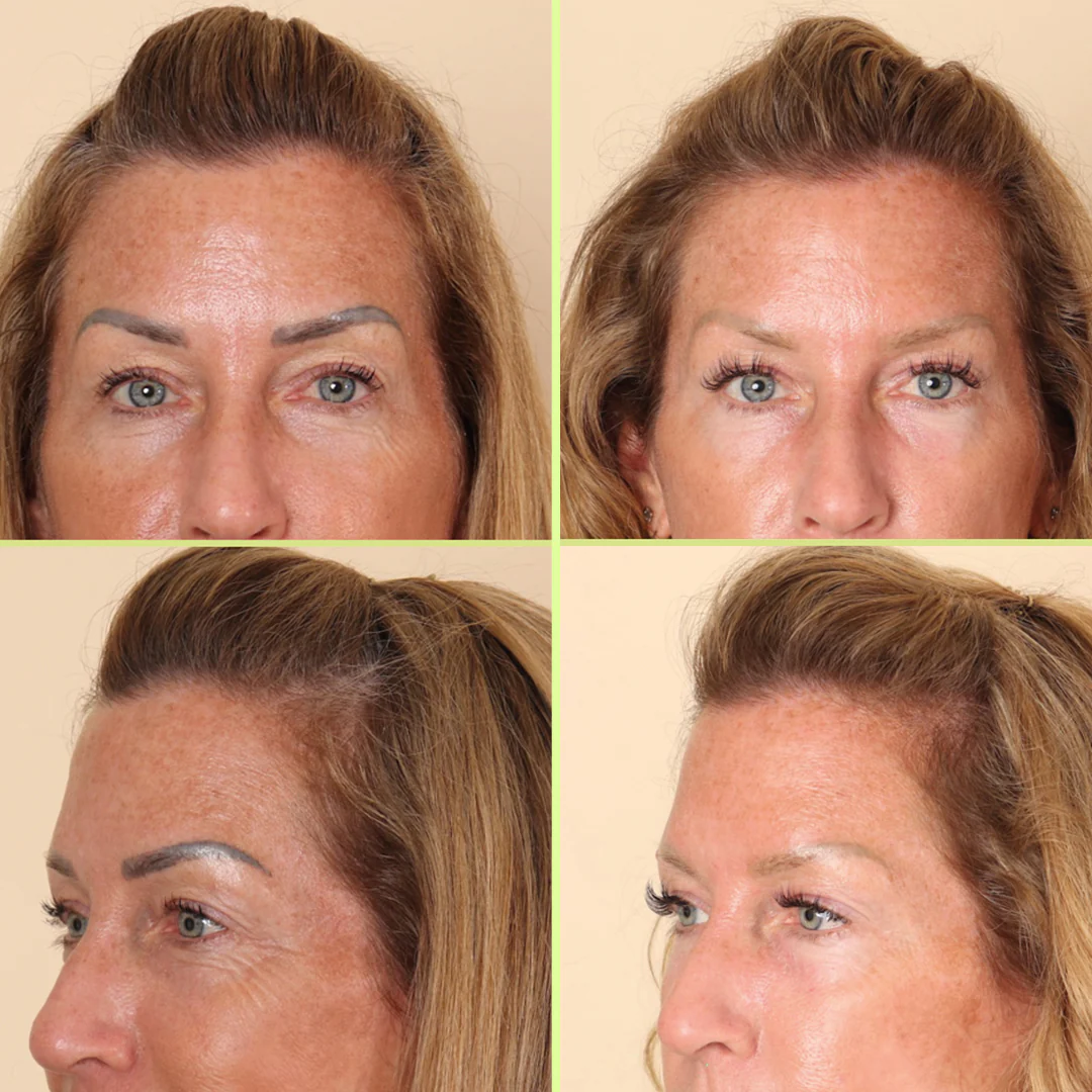Removal results after just 4 treatments at NAAMA.