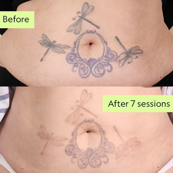 Sally tattoo removal before and after