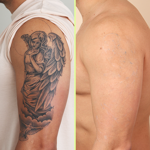 Arm tattoo removal